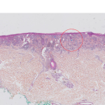 Cleo Skin, 1er outil IA de dermatopathologie a obtenir le marquage CE-IVDR