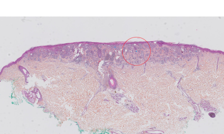 Cleo Skin, 1er outil IA de dermatopathologie a obtenir le marquage CE-IVDR